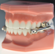 orthodontics-footscray-traralgon-crooked-health-straight-teeth